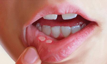 روشی برای بهبود آفت های دهان