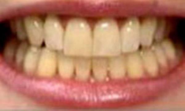 آیا رنگ دندانهایتان زرد است؟